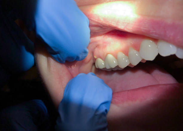 Best Emergency Treatment for Dental Infections or Abscesses in Maysville, OK